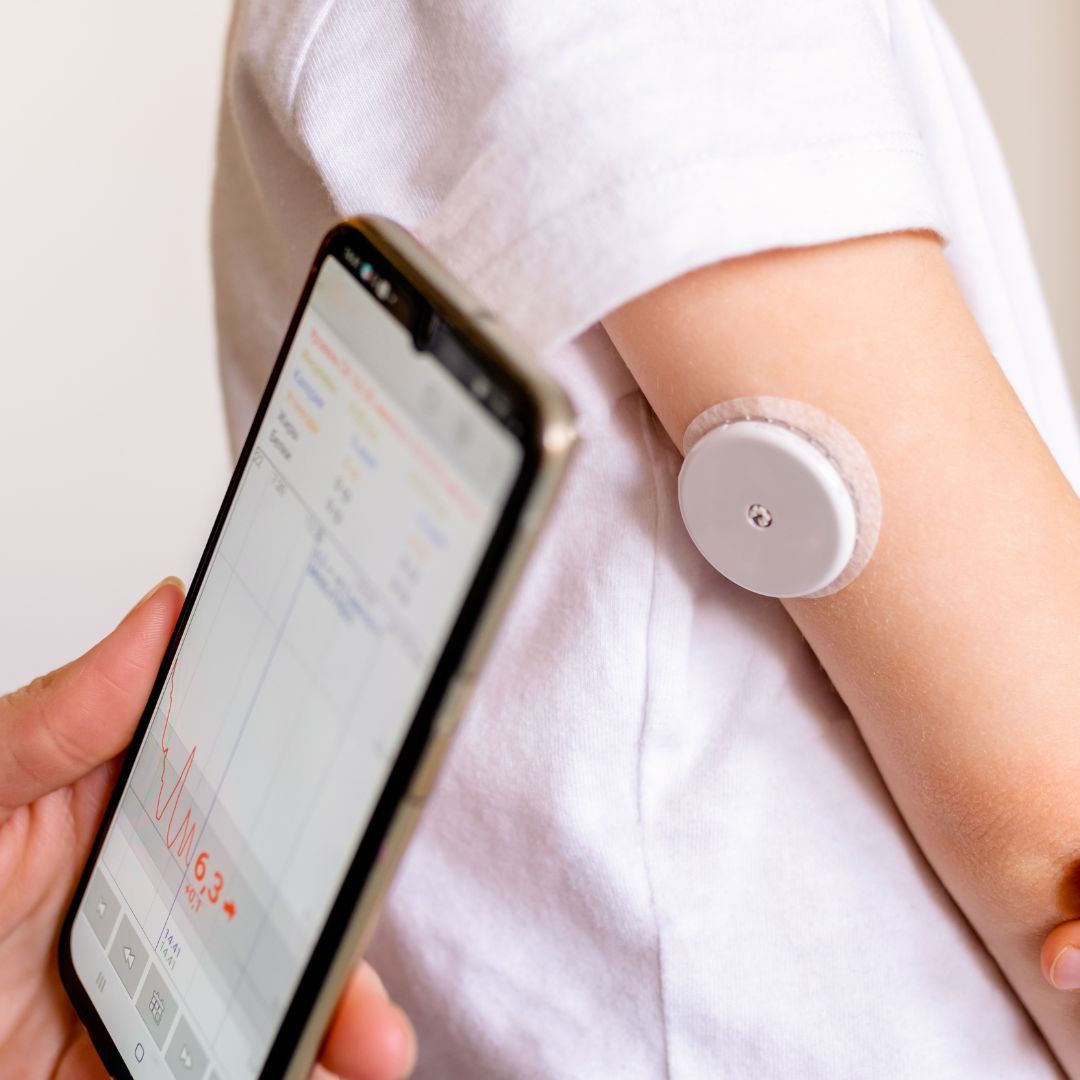 Smartphone tracking blood glucose from a CGM device